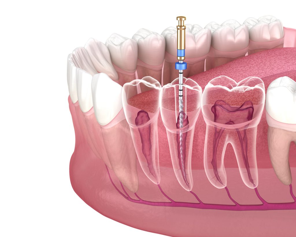 Root Canal Helotes TX